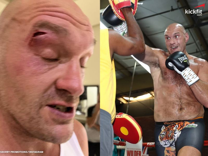 Tyson Fury bị thương ở vùng mắt khi đang tập luyện cho trận thống nhất đai