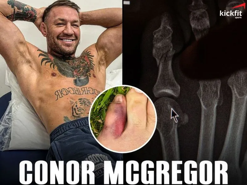 Conor McGregor bỏ đấu UFC 303 vì gãy ngón chân út