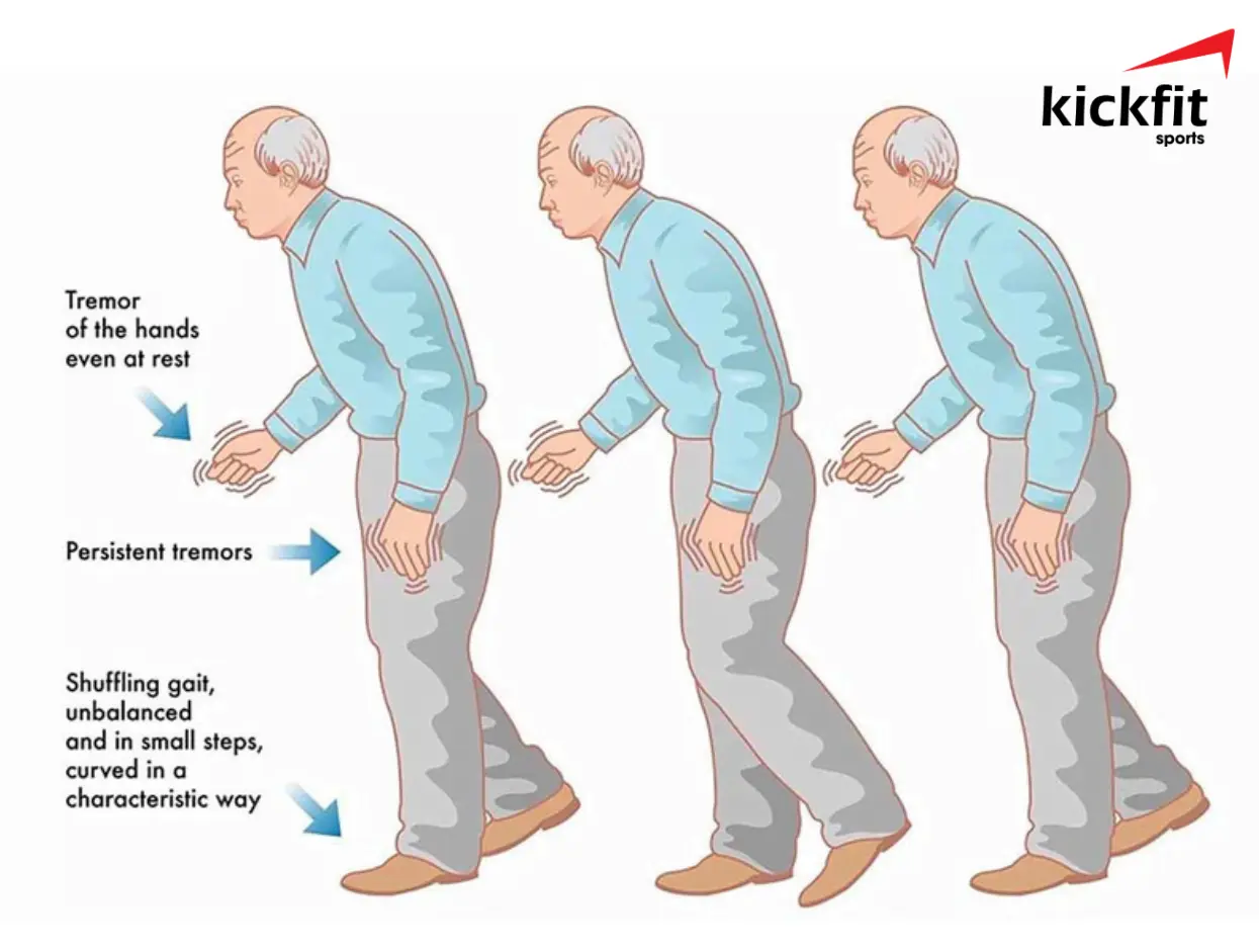 Lợi ích của Thái Cực Quyền trong việc điều trị bệnh Parkinson ở người già