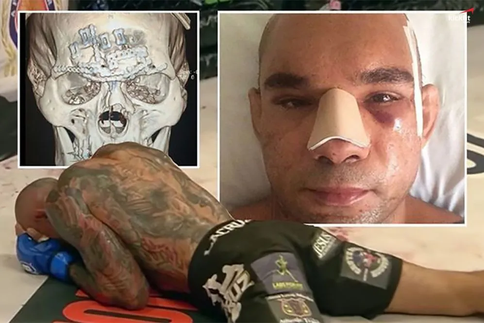 Top 10 chấn thương trong MMA kinh hoàng nhất mà các võ sĩ phải hứng chịu