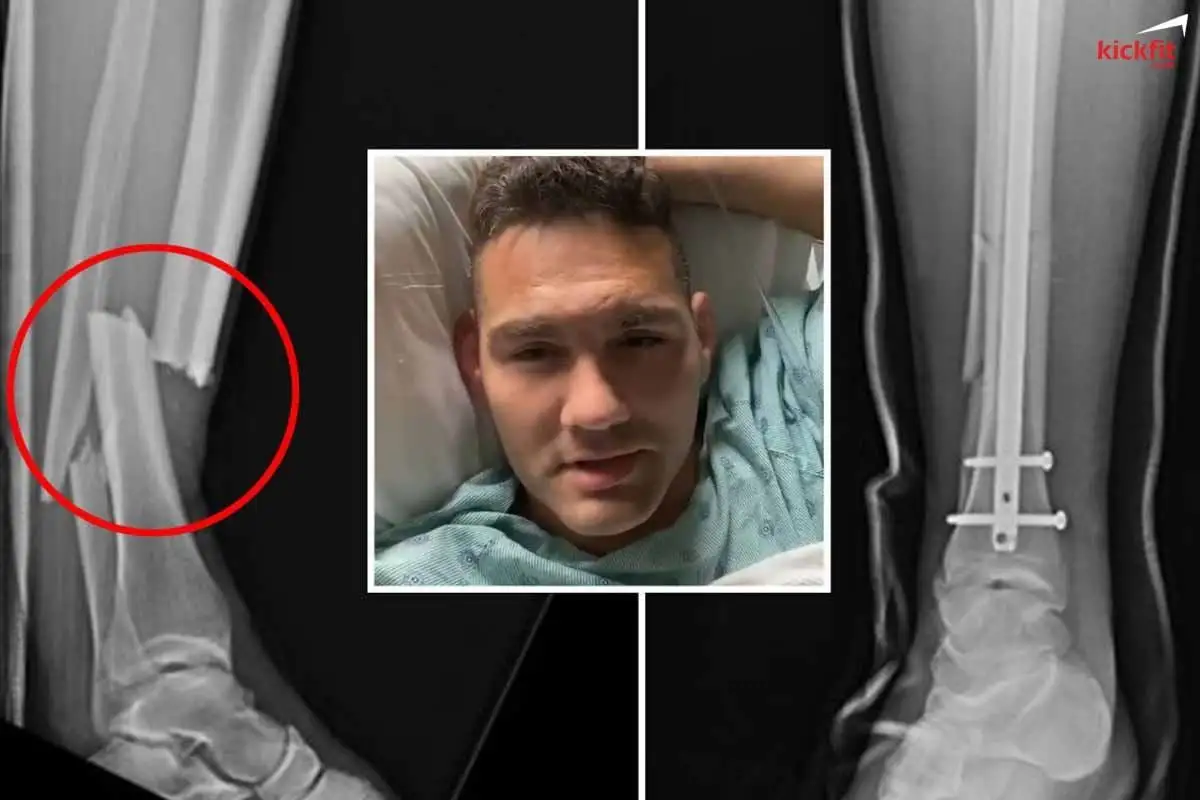 Tay đấm Chris Weidman đang lo sợ phải cắt cụt chân vì chấn thương khủng khiếp tại UFC 261